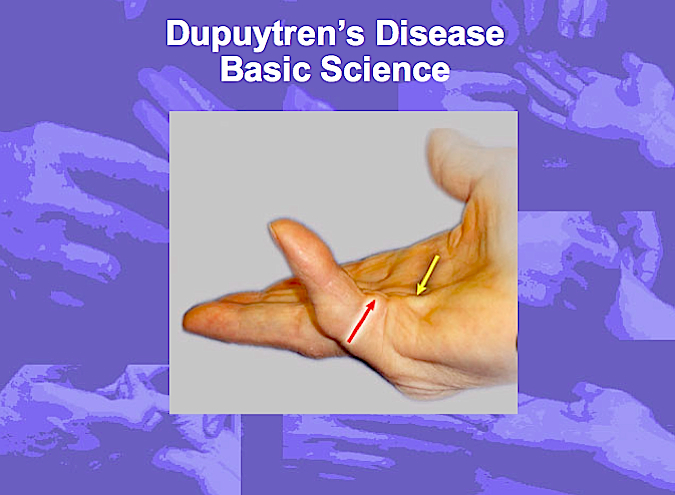 Dupuytren's Disease Basic Science (Hover over right edge to see more images)