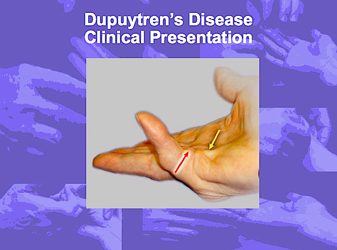 Clinical presentation of Dupuytren's Disease (Hover over right edge to see more images)