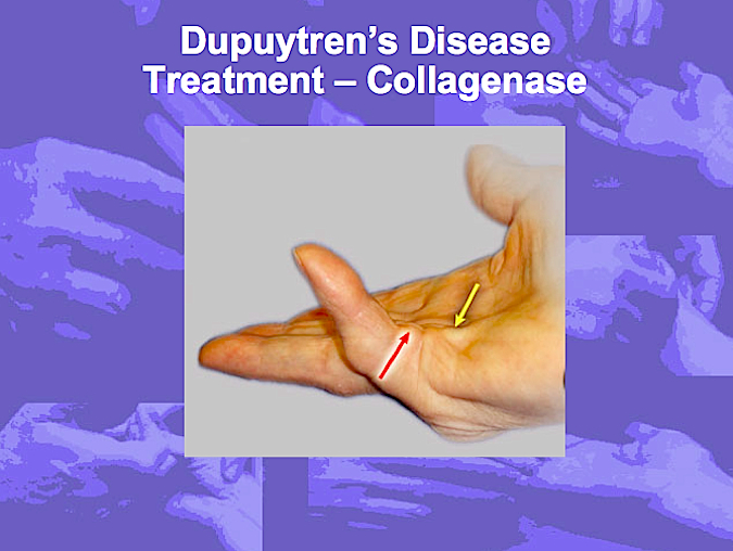 Collagenase Treatment for Dupuytren's Disease (Hover over right edge to see more images)