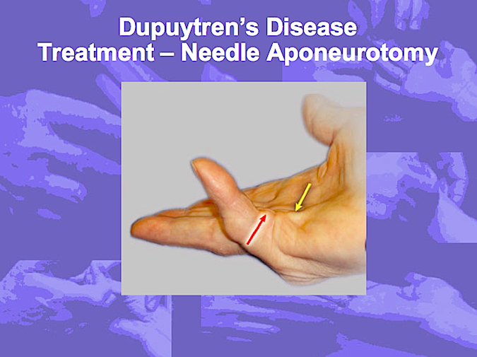 Needle Aponeurotomy (Hover over right edge to see more images)