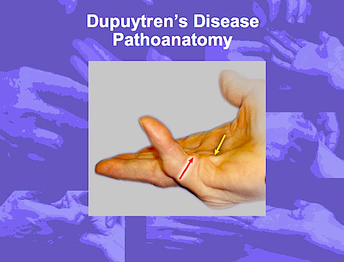 The Pathoanatomy of Dupuytren's Disease (Hover over right edge to see more images)