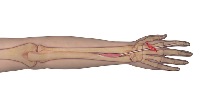 This illustration represents the anatomy of the muscle and tendon origin and insertion. Should an individual sustain a laceration as depicted, the observer can assume that the underlying tendon may be at risk for complete transection. A proper examination is needed to determine the integrity of the tendon.