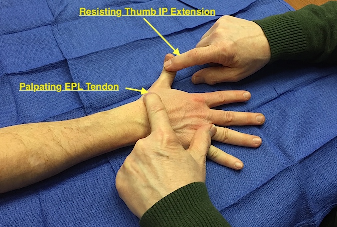 EPL Muscle Testing. Note EPL tendon visible and palpable.