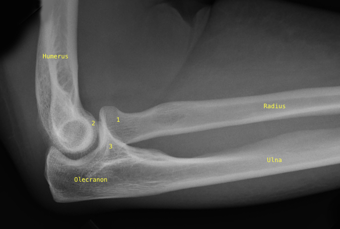 Elbow Lateral: 1- Radial Head; 2-Capitellum; 3- Coronoid 