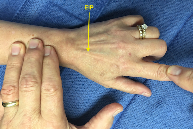 Extensor Indicis Proprius (EIP) extending index MP while long and ring held in flexion and examiner's left hand fingers palpate the muscle belly..