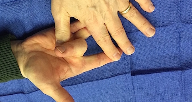 Flexor Digitorum Superficialis (Sublimus) Tendon testing right hand