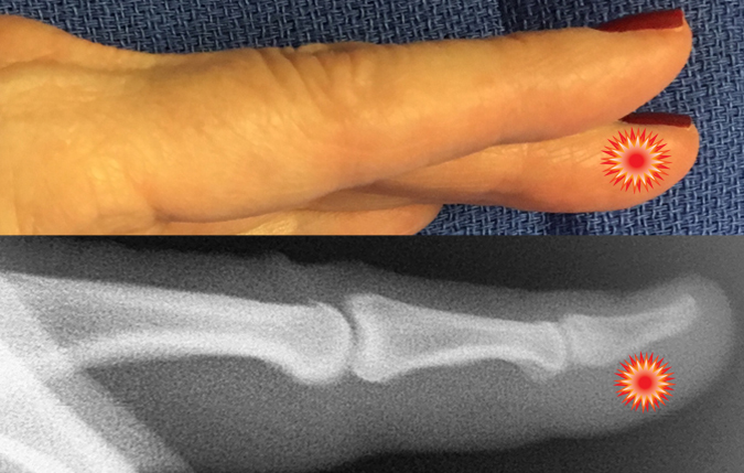 The red "tender"  sign pin points the area of tenderness in relationship to the distal phalanx, DIP joint and the surface anatomy of a patient with a felon.