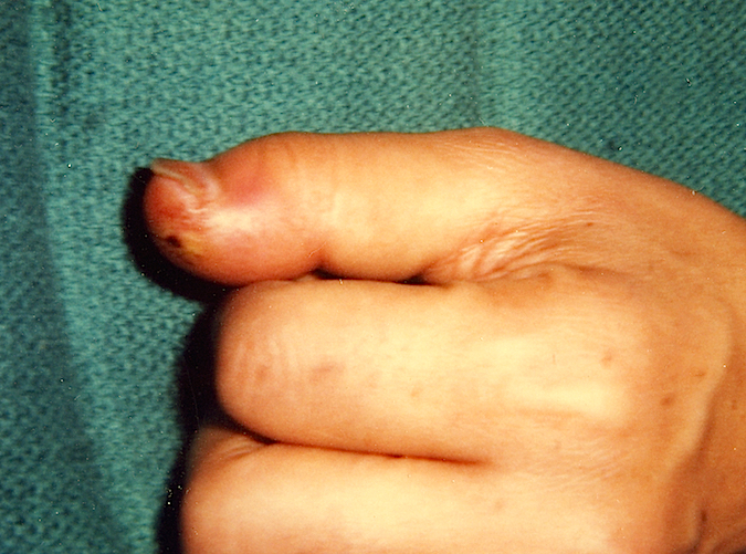 Felon Right Thumb (Hover over right edge to see more images)