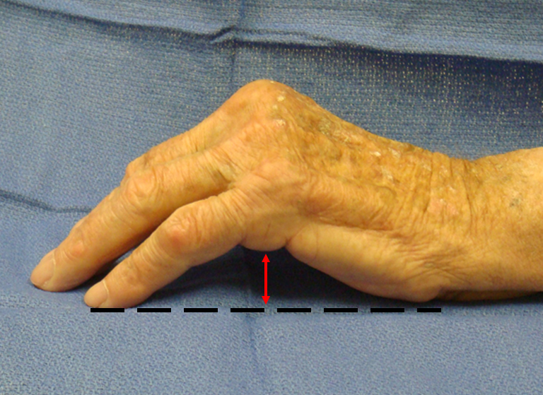 Dupuytren's Disease Signs - Classic Positive table top test