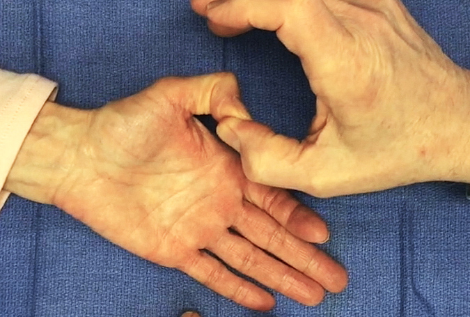 Flexor Pollicis Longus Tendon testing left hand