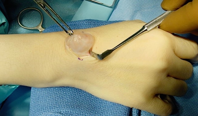 Excision of Dorsal Carpal Ganglion