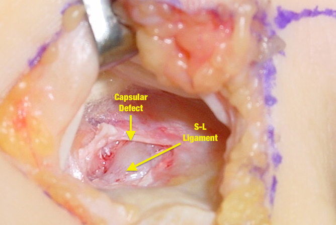 Dorsal Capsule after ganglion excision.