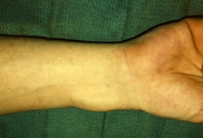 Volar Carpal Ganglion