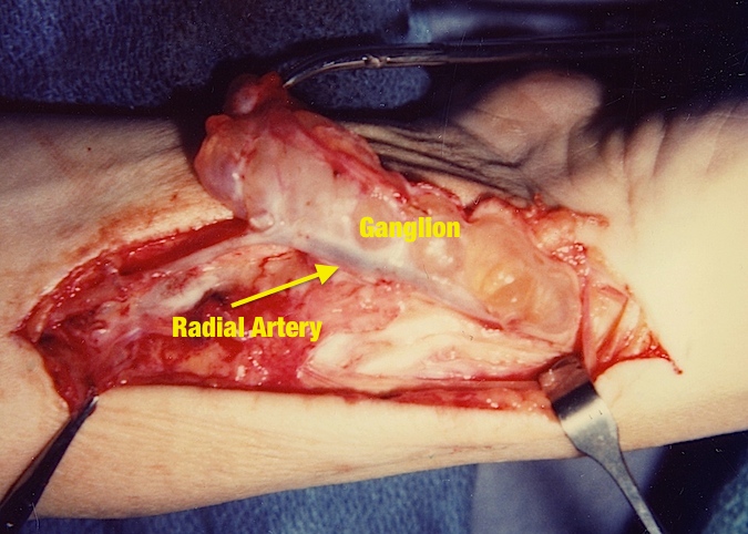 Volar Ganglion being dissect off radial artery.