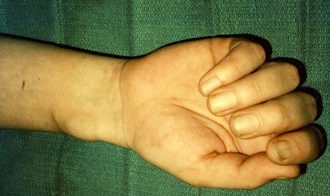 Volar Carpal Ganglion with palpable pulse 