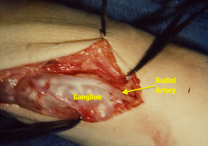 Volar Ganglion Adherent to radial artery.