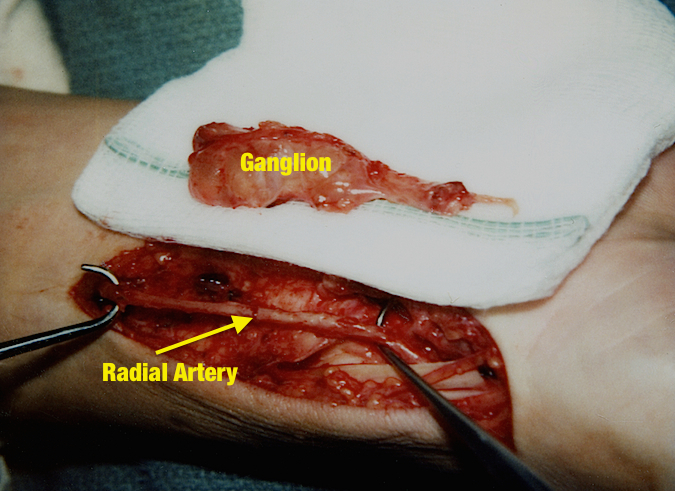 Excised Volar Ganglion with intact radial artery.