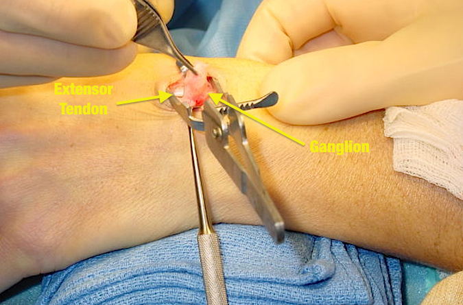 Excision of Dorsal Carpal Ganglion (Hover over right edge to see more images)