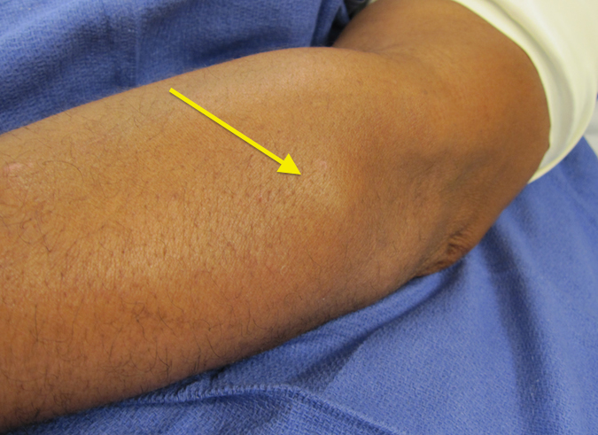 Lipoma Proximal Dorsal Forearm with PIN Palsy (Hover over right edge to see more images)