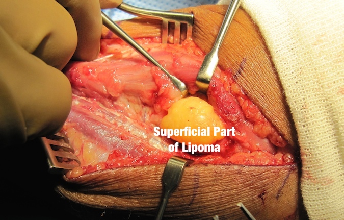 Lipoma Proximal Dorsal Forearm with PIN Palsy