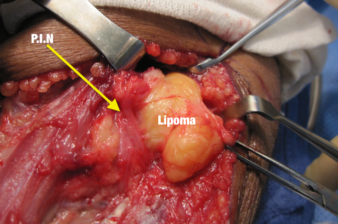 Lipoma Proximal Dorsal Forearm with PIN Palsy