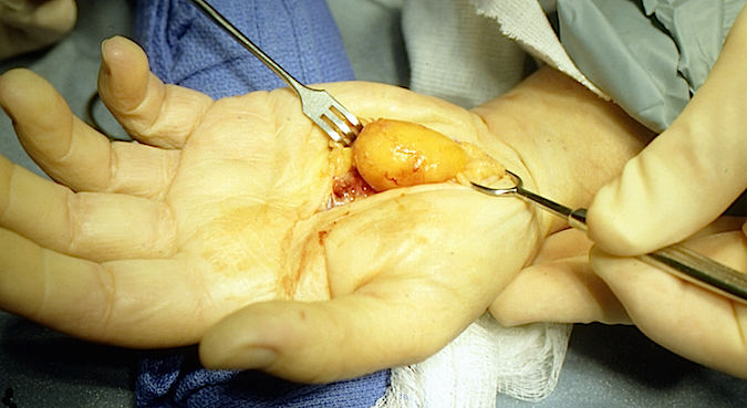 Excision of lipoma from the carpal tunnel