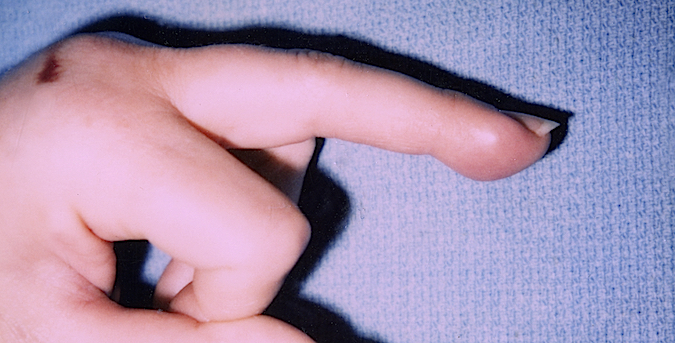 Lateral view of lipoma in finger tip