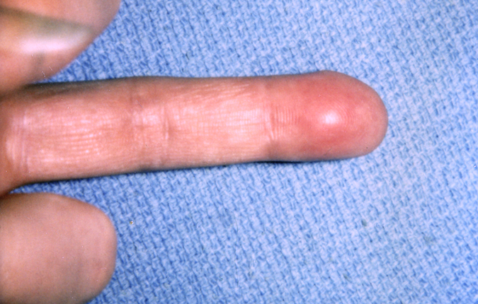 Palmar view of lipoma in finger tip