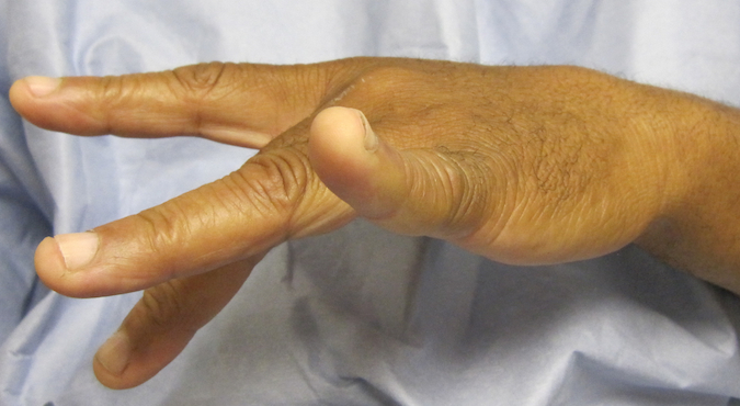 Partial PIN Palsy secondary to Lipoma Proximal Dorsal Forearm 