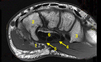 MRI showing cross section of carpal tunnel. 1.Ulnar nerve; 2.Hamate and hook of hamate;  3. Trapezium and trapezoidal ridge;  4. Median nerve; 5. Transverse carpal ligament; 6. Flexor tendons