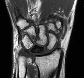 MRI Wrist T1 Kienbock's Disease 