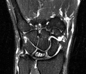 MRI Wrist 2  Kienbock's Disease 