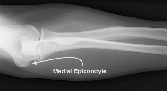 In golfer's elbow the X-ray of the elbow is usually normal. Occasion calcifications of the flexor origin will be seen.