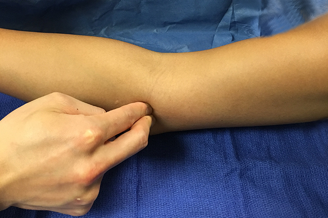 Palpating medial epicondyle for point tenderness without resisted wrist.  (Hover over right edge to see more images)