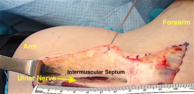 Cubital Tunnel Syndrome- Note edge of intramuscular Septum. A section of this should be removed when doing anterior transposition of the ulnar nerve. (Hover over right edge to see more images)