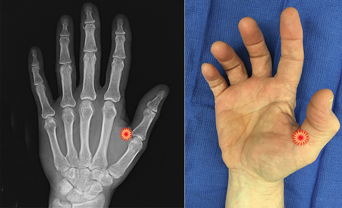 The red "tender"  sign pin points the area of tenderness in relationship to the metacarpal, phalanx, MP joint and the surface anatomy of a patient with a trigger thumb.