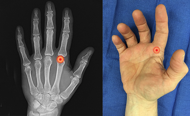 The red "tender"  sign pin points the area of tenderness in relationship to the metacarpal, phalanx, MP joint and the surface anatomy of a patient with a index trigger finger.