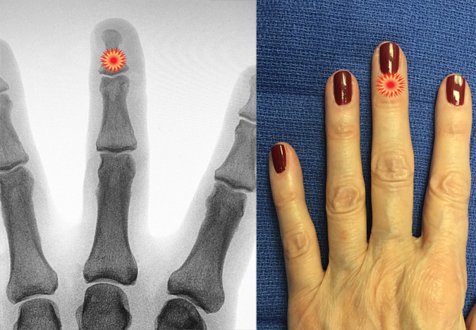 The red "tender"  sign pin points the area of tenderness in relationship to the middle phalanx, distal phalanx, DIP joint and the surface anatomy of a patient with a paronychia.