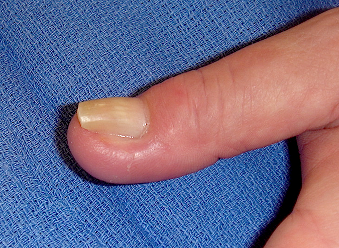 Early paronychia with previous nail damage (Hover over right edge to see more images)