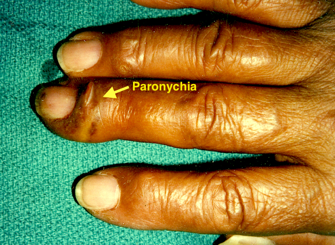 Paronychia Long Finger (Hover over right edge to see more images)