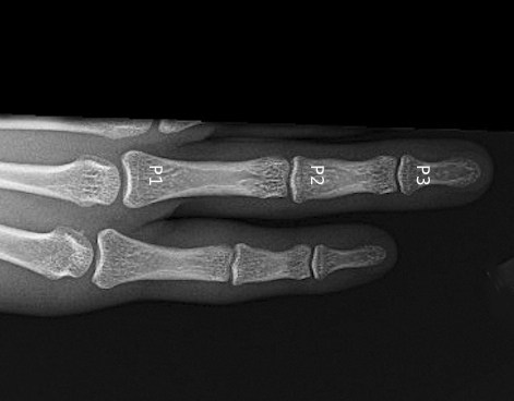 X-ray Normal in Trigger Fingers. P1=Proximal Phalanx; P2=Middle Phalanx; P3=Distal Phalanx