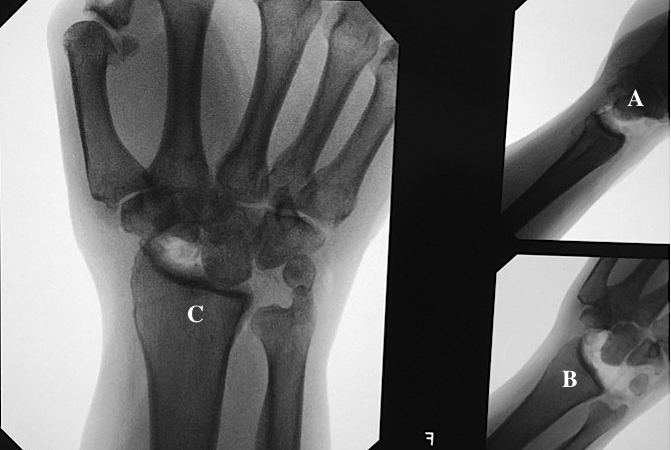 Proximal row excised completely. Traction views (A&B) and capitate in lunate fossa (C).