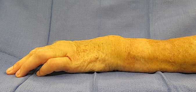 Silver fork deformity in young patient with a untreated partially healed distal radius fracture