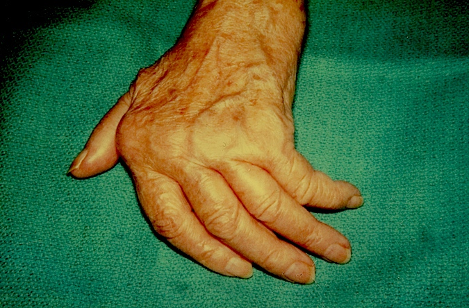 Classic Rheumatoid right hand with ulnar drift of fingers and subluxed MP joints (Hover over right edge to see more images)