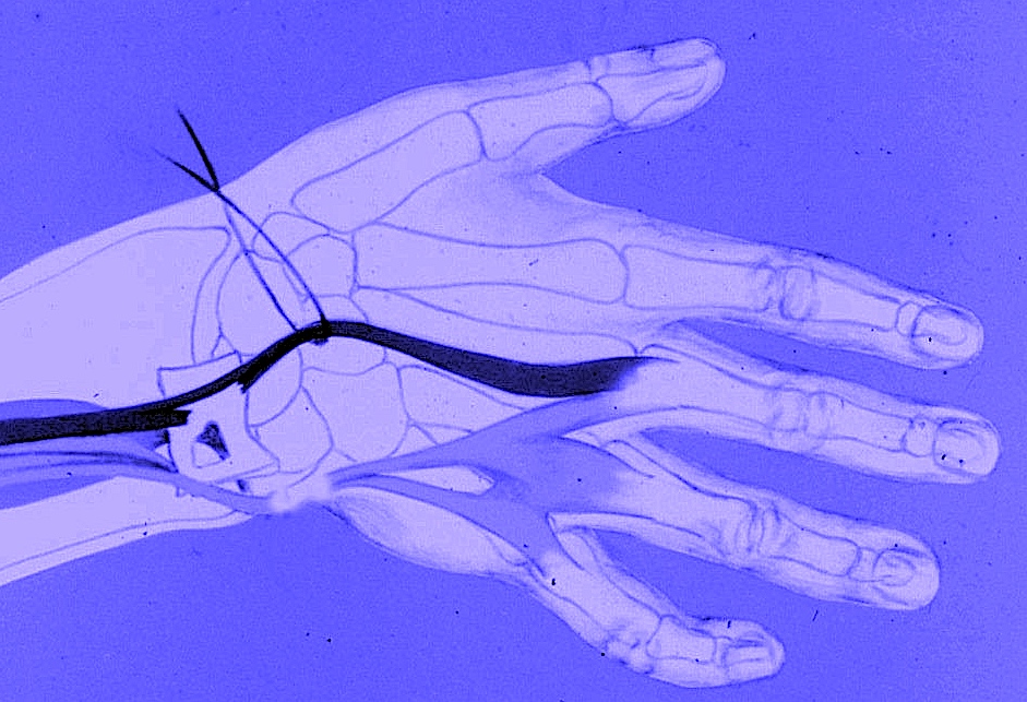 Extensor tendon ruptures in RA; Ulna suluxates dorsally because it's arthritic rough edges wear through the DRUJ capsule and then cut the tendons.