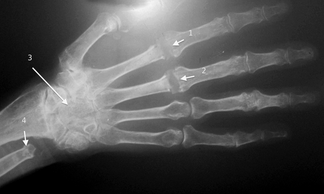 Xray of rheumatoid hand - Noted (1&2) Replaced index and long MP joints, (3) Destroyed but stable wrist and (4) distal ulna previously resected secondary to a damaged joint and pain with forearm rotation.