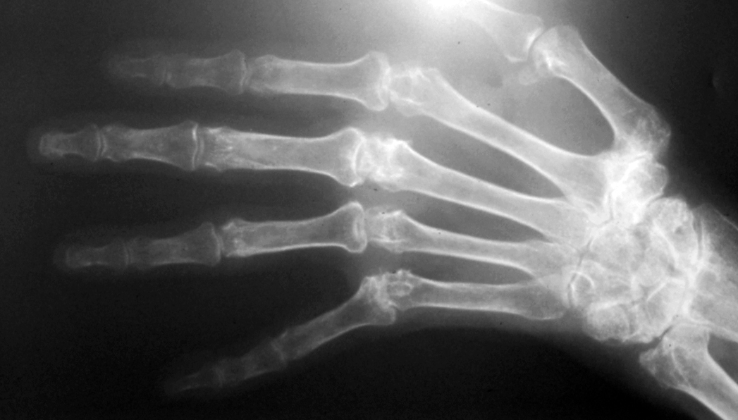 Xray of rheumatoid hand - Noted destroyed wrist, finger MP joints and thumb CMC joint (Hover over right edge to see more images)