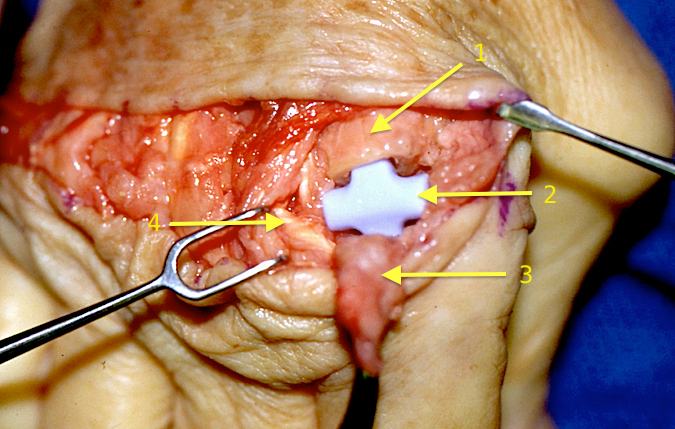 Index MP joint replacement for RA. (1) Metacarpal head, (2) Silicone prosthesis, (3) Joint capsule for later repair (4) Extensor tendon (Hover over right edge to see more images)