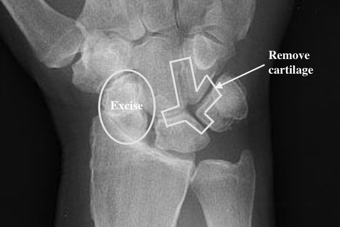 Surgical plan for scaphoid excision and 4 corner fusion