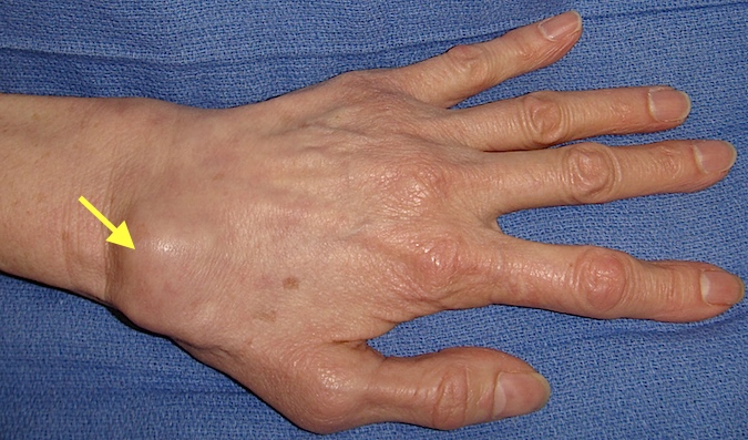 Arthritic wrist secondary to scapholunate advanced collapse (SLAC Wrist)